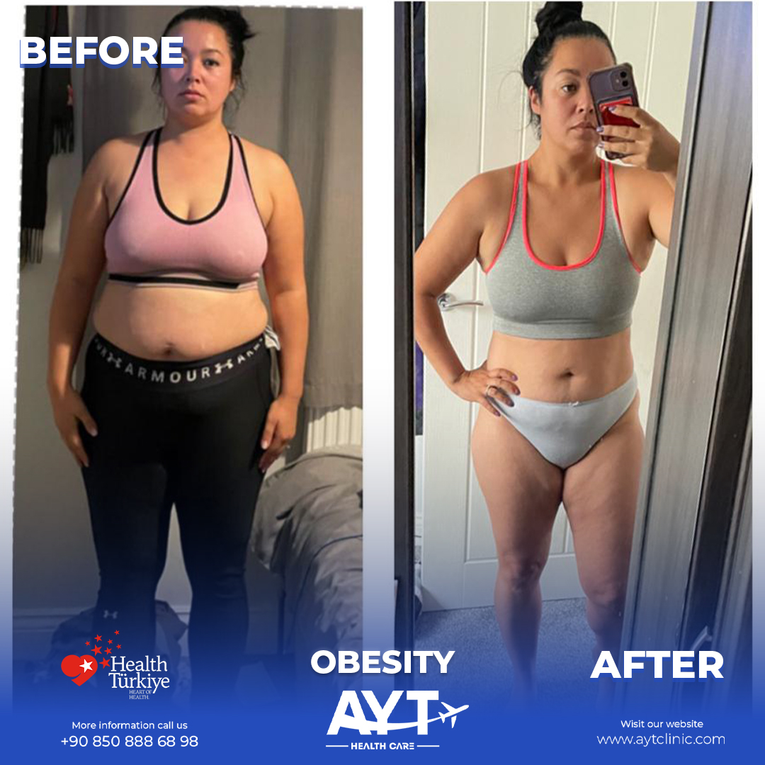 Who Is Suitable for Weight Loss Surgery in Turkey?