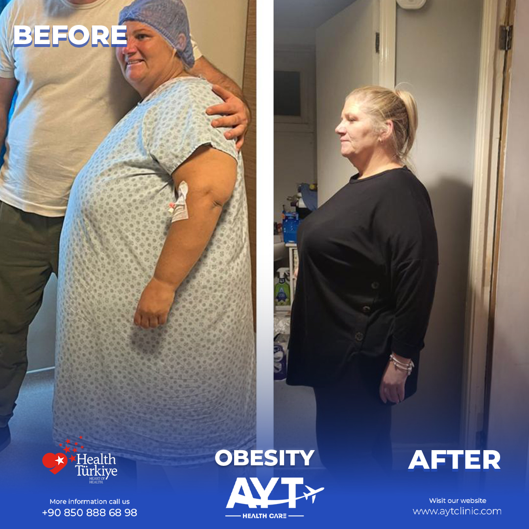 Why Choose Turkey for Weight Loss Surgery?