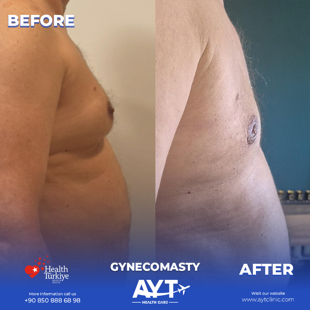 Gynecomastia