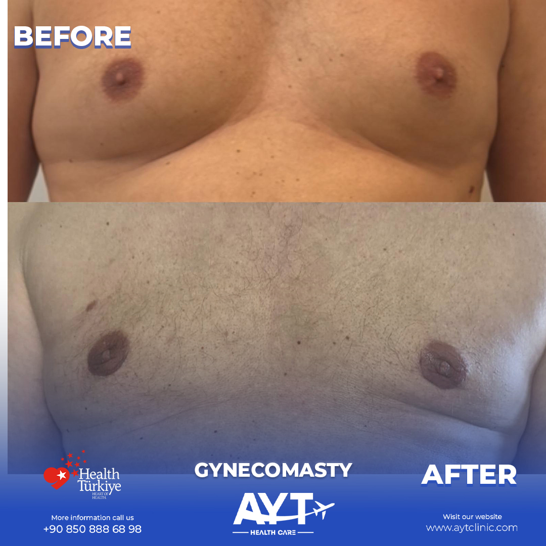 Gynecomastia