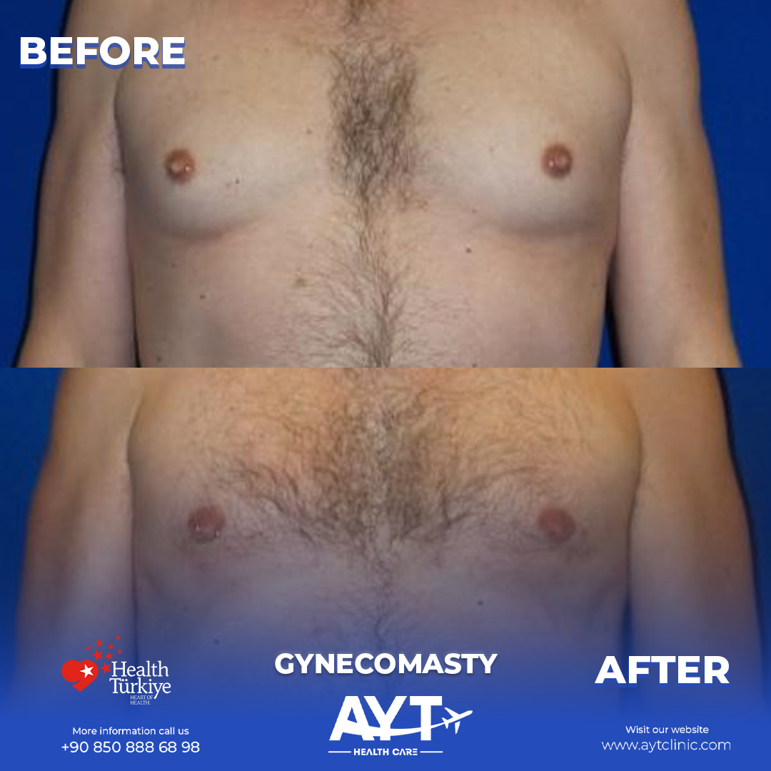 Gynecomastia