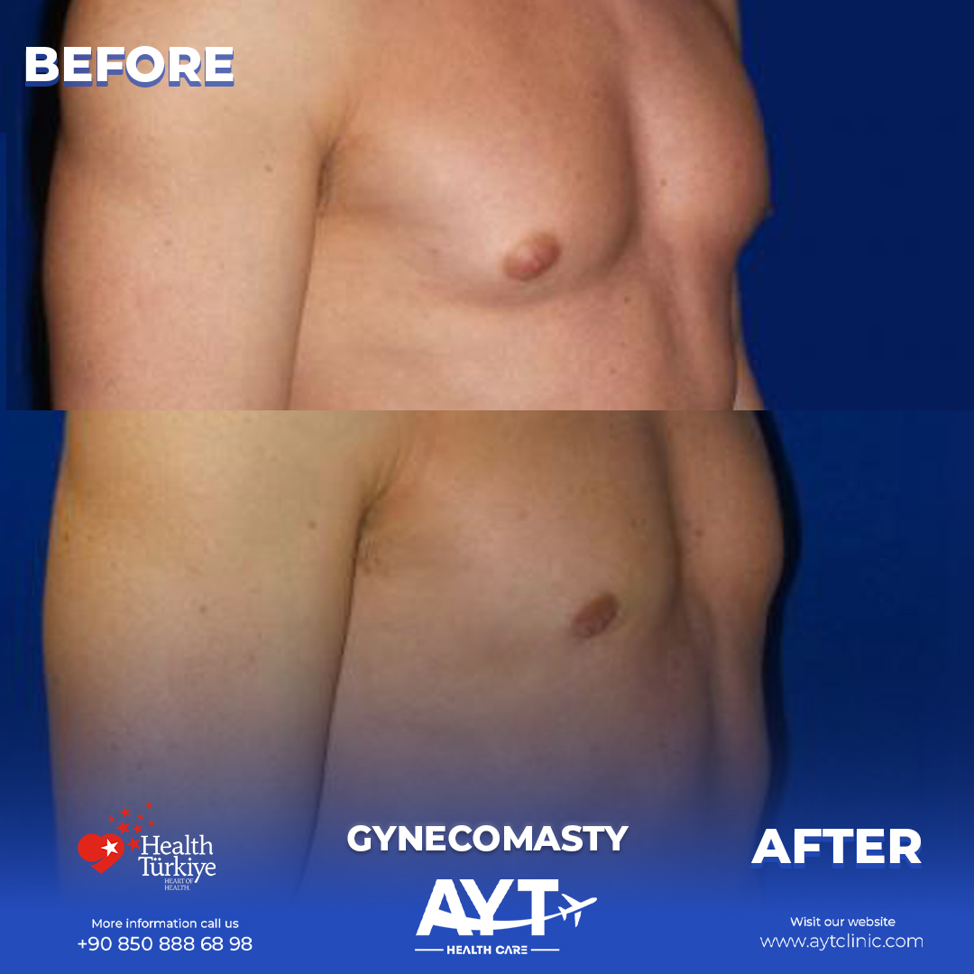 Gynecomastia