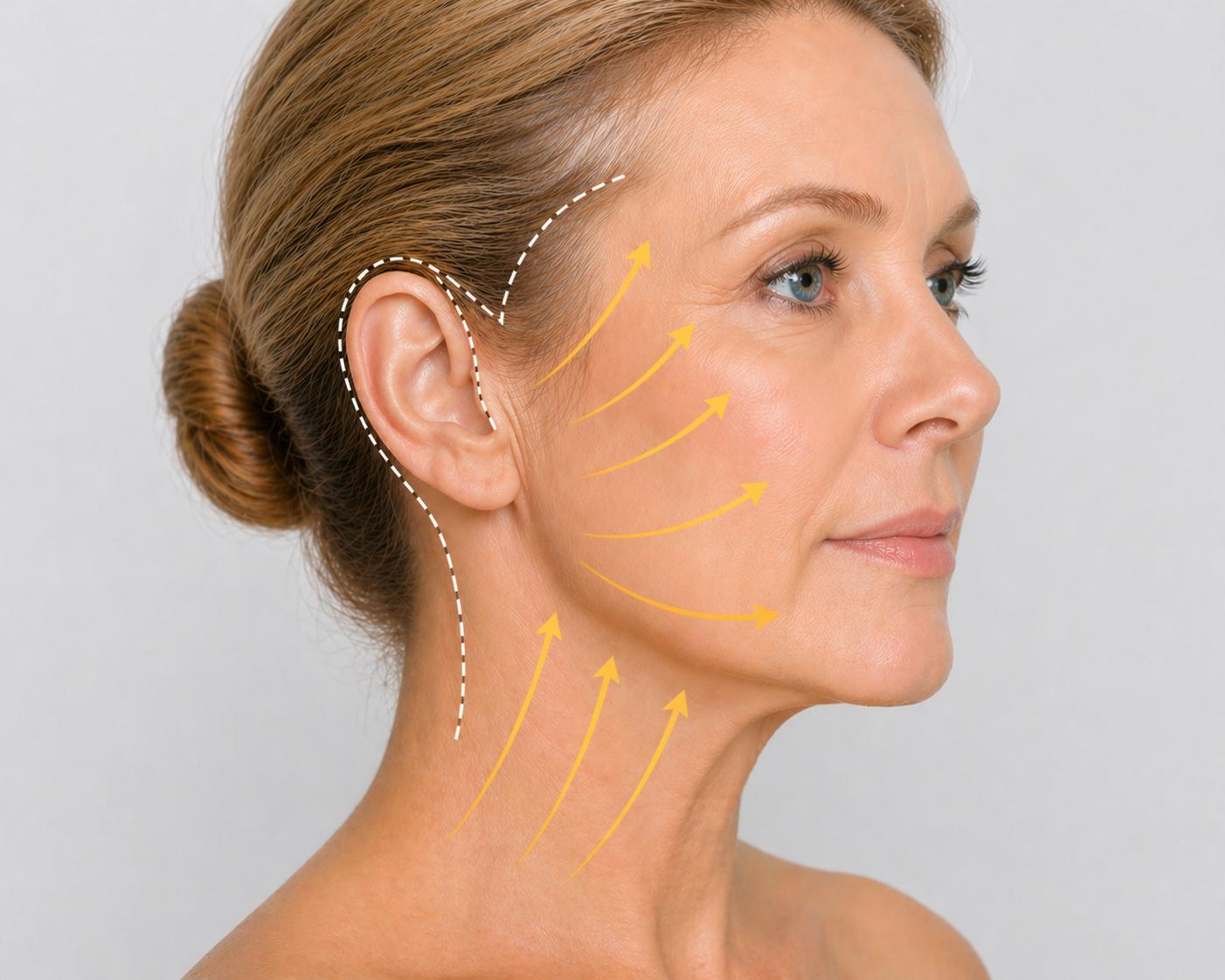 Traditional Face Lift