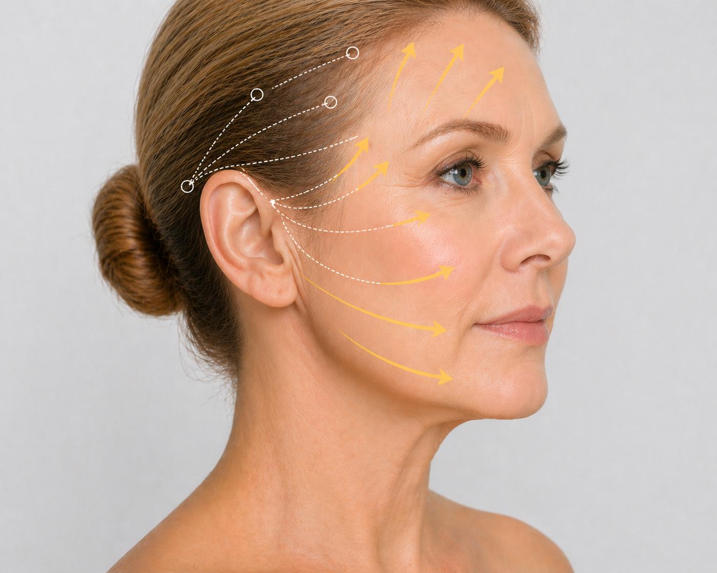 Endoscopic Face Lift