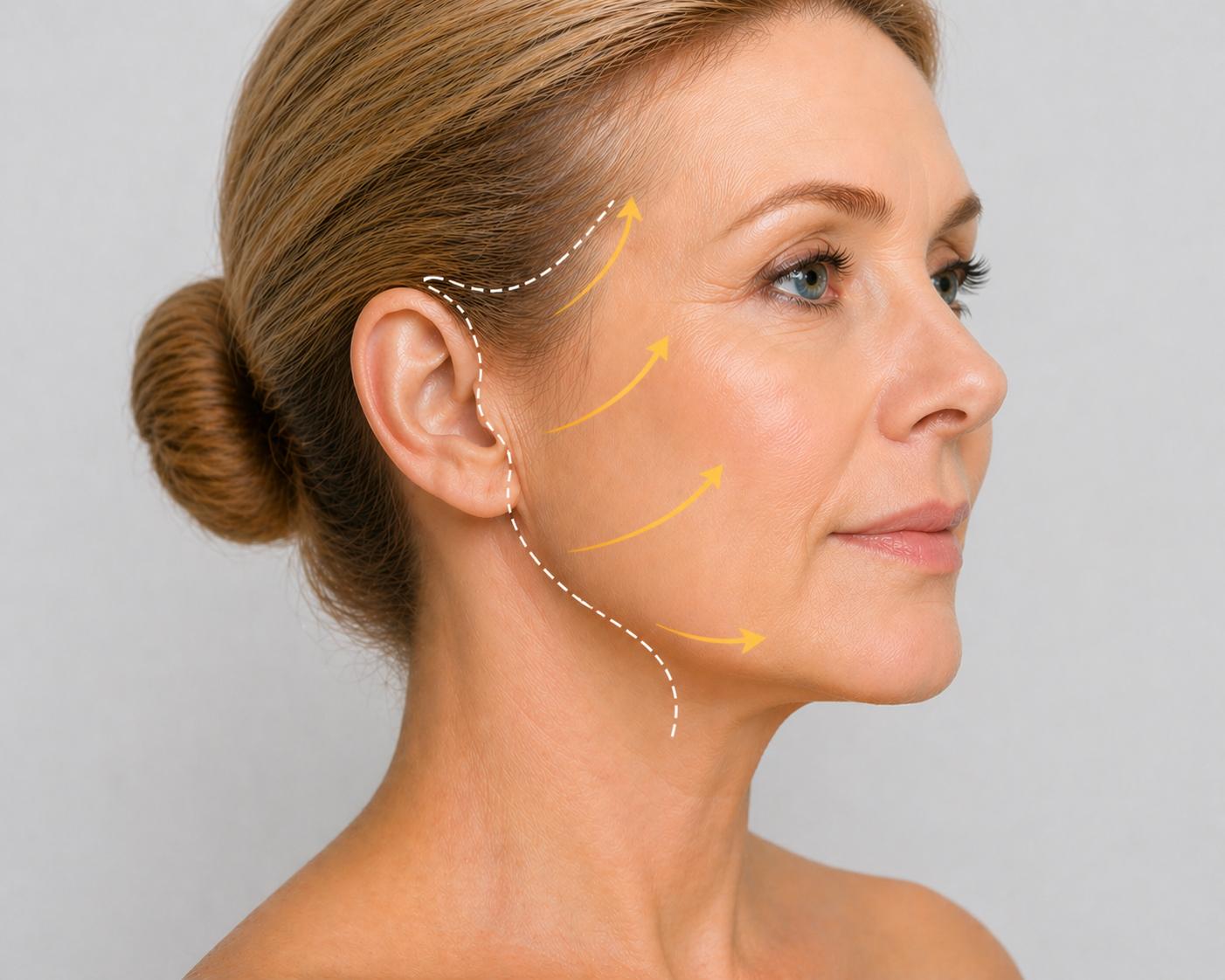 Mini Face Lift