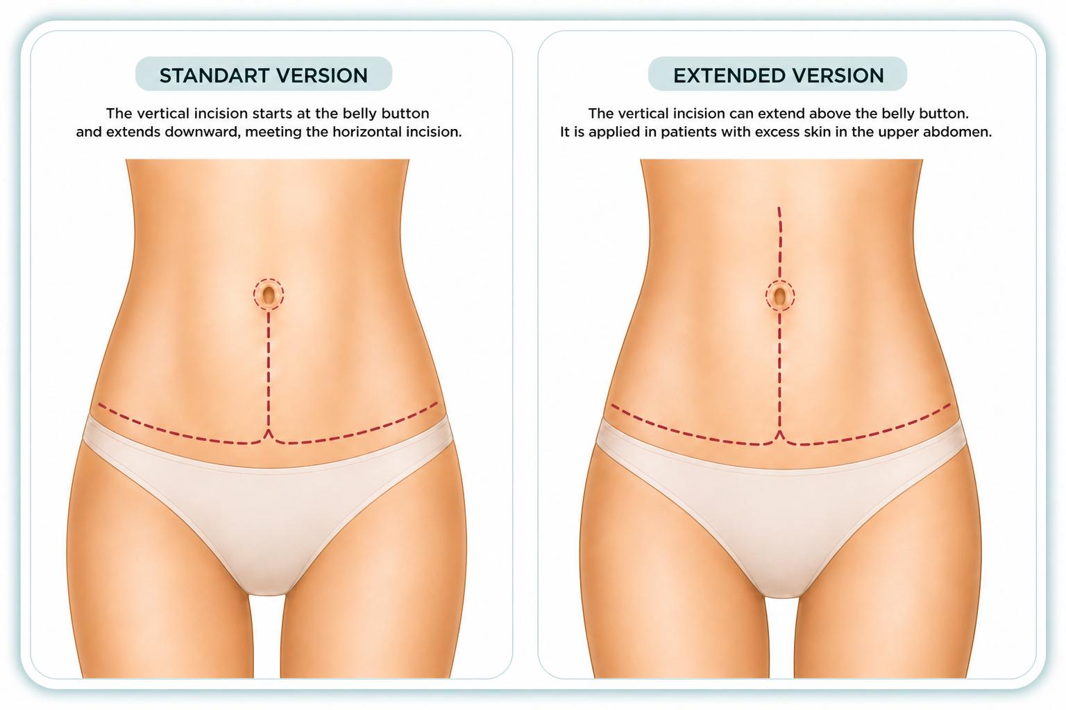 FDL Tummy Tuck