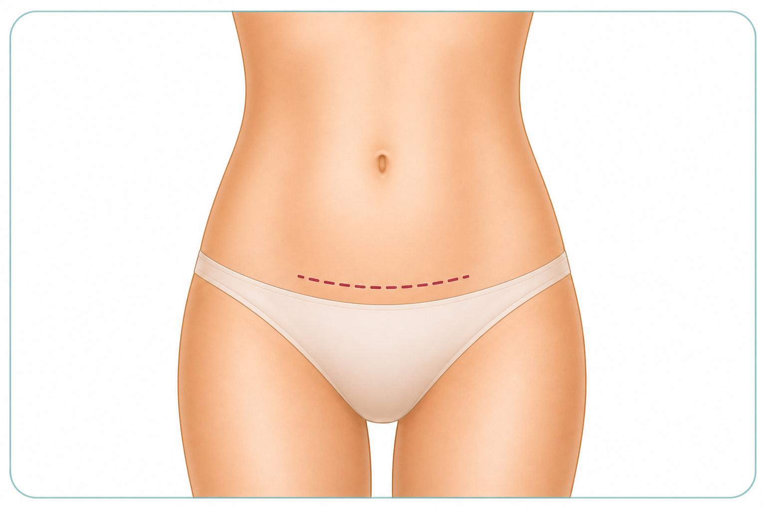 Mini Tummy Tuck