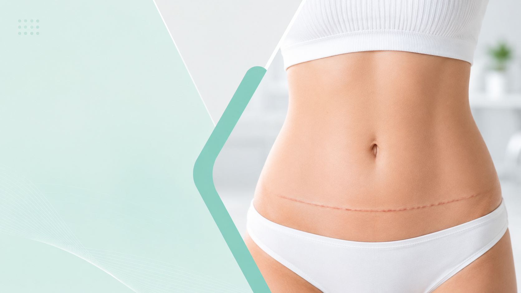 Tummy Tuck Aftercare