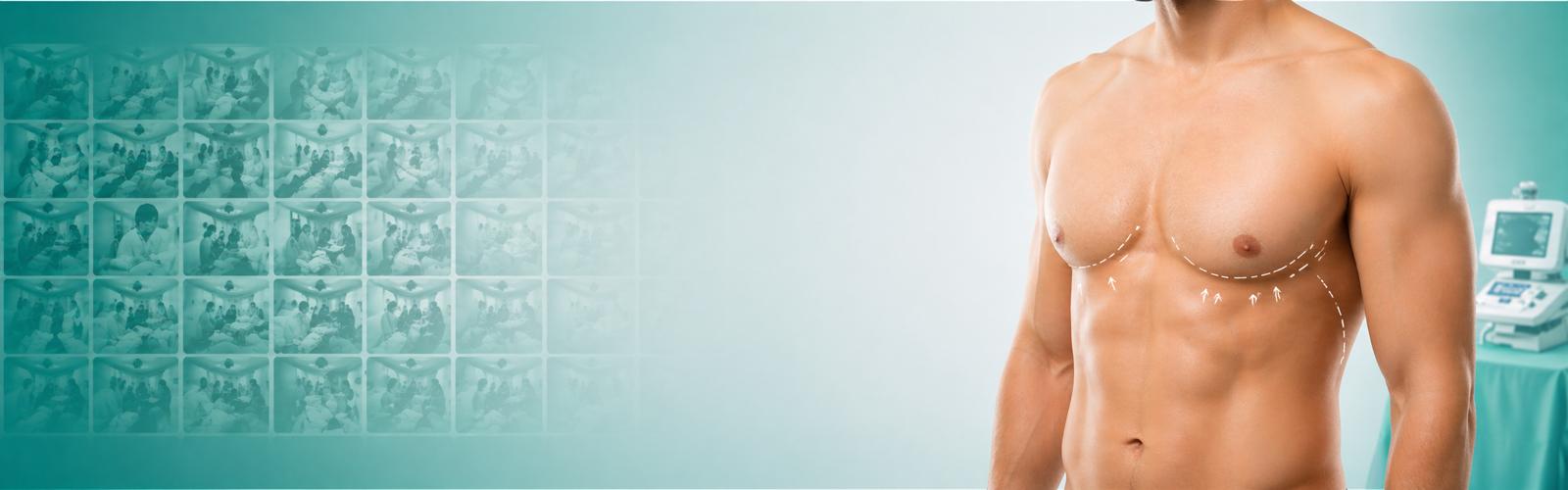 Gynecomastia