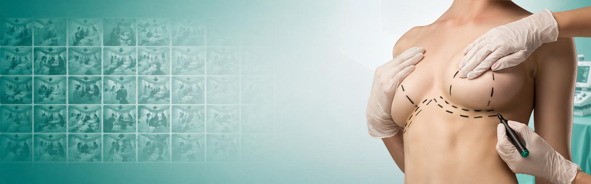Breast Reduction